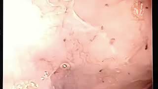 Infección parasitaria