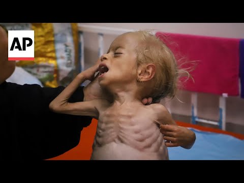 YouTube video thumbnail: Malnourished Children Arrive at Gaza Hospital as Netanyahu Denies Hunger