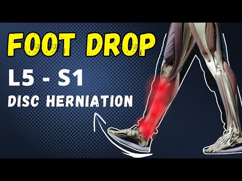 L5 S1 disc herniation & foot drop recovered without surgery (online client testimonial) #australia