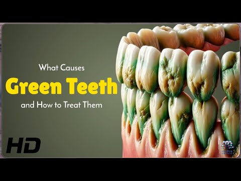 Green Teeth Explained: Causes and Simple Solutions 🦷