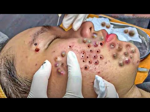 Blackhead Removal With Today Spa #2440