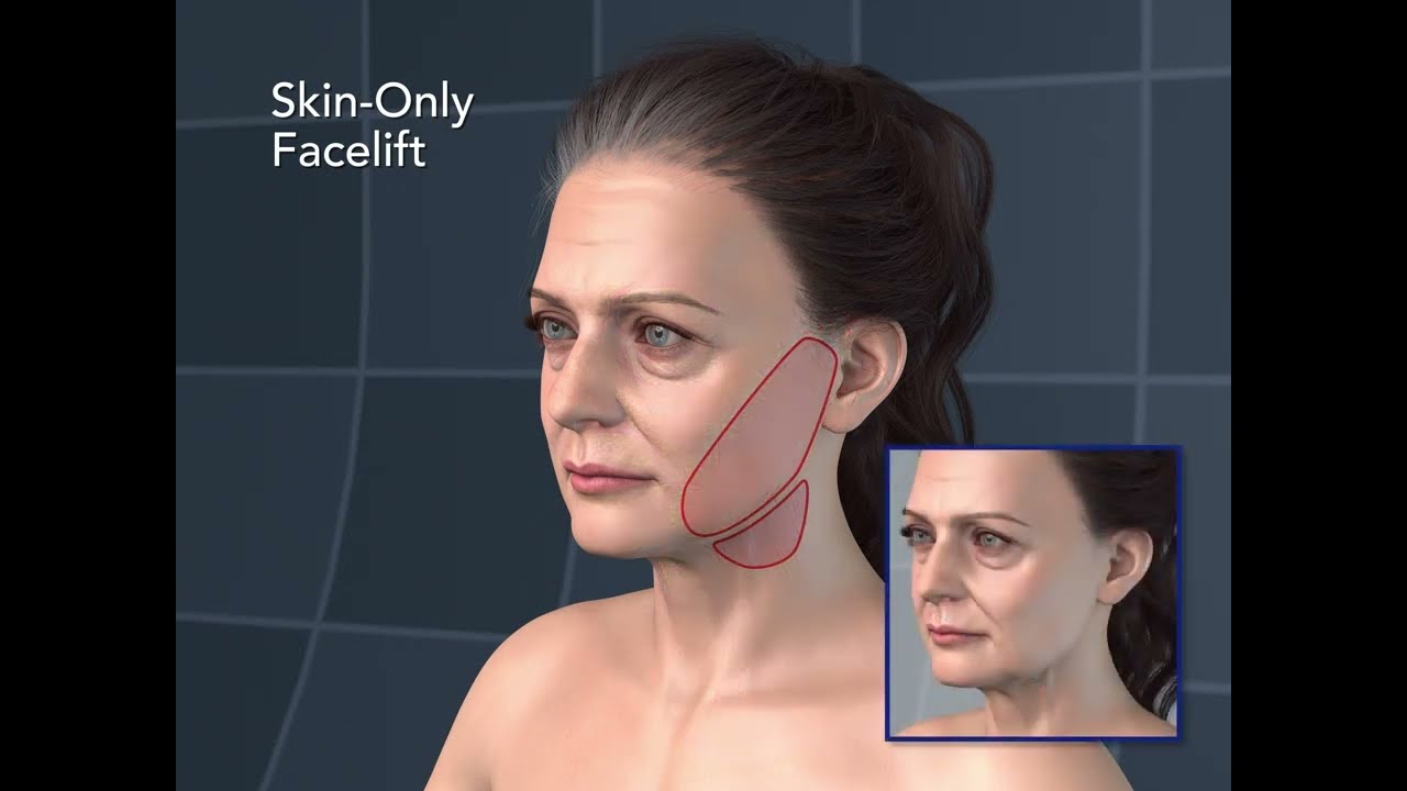 Skin-only facelifting technique and illustration.