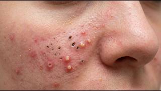 Loan Nguyen Acne Treatment 08x