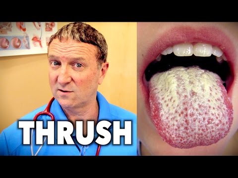 THRUSH | Dr. Paul