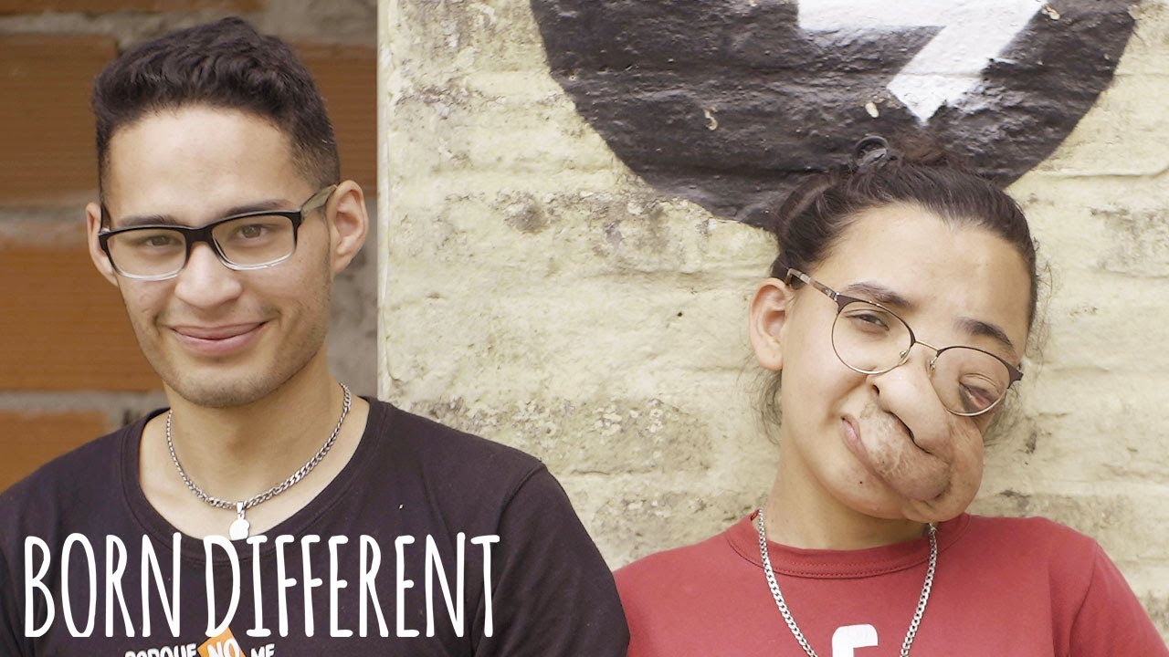 My facial tumour hasn't stopped me finding love - born different