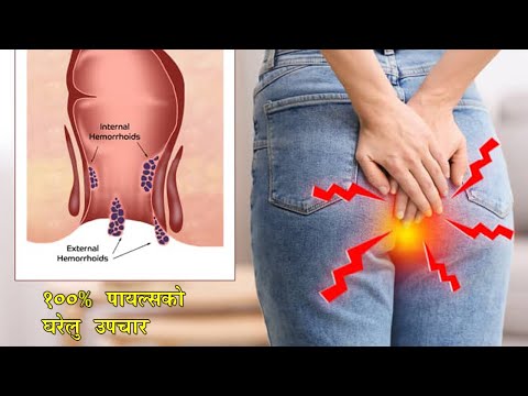 Piles Ko 100% Upachar - पायल्सको १००% उपचार घरेलु विधिबाट - Home remedies For Piles