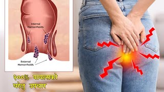 Piles Ko 100% Upachar - पायल्सको १००% उपचार घरेलु विधिबाट - Home remedies For Piles