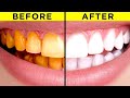 Teeth Whitening and Oral Hygiene