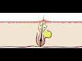 Acne Formation and Treatment Concepts