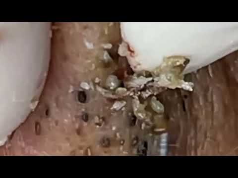 Blackheads & Whiteheads Satisfying Removal @0369