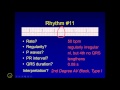 AV Block Characteristics and Treatments