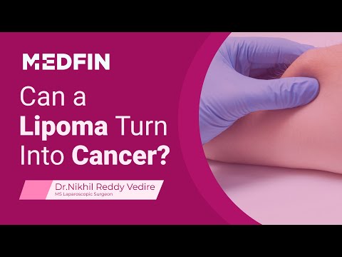 <p>Can Lipoma Cause Cancer? Are Lipomas Dangerous? | FAQs</p>