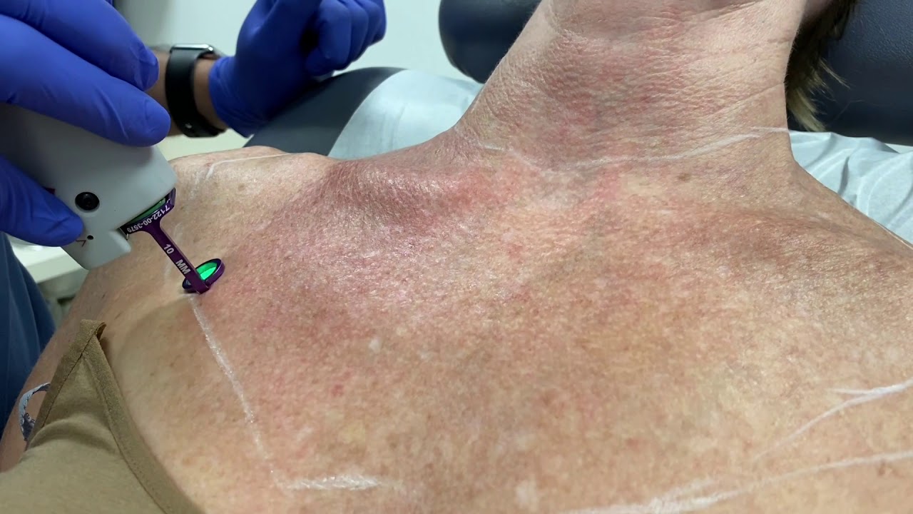 Woman with markings for cosmetic procedure preparation.