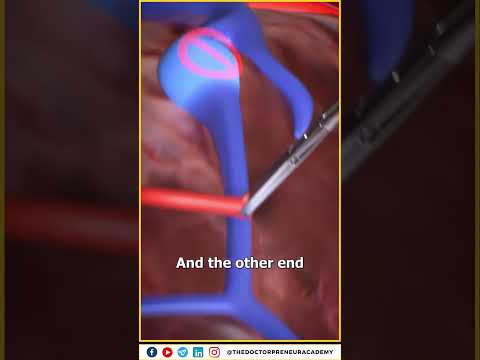 How Vein Grafts Save Lives: A Miracle in Cardiac Surgery! ๐ฉบโจ #doctorlife