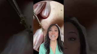 Double DPOW or cyst with two heads???