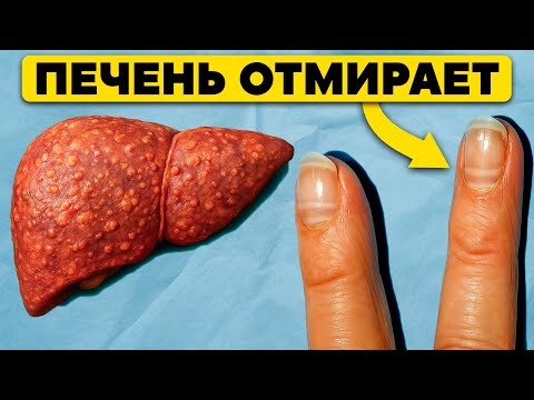 Печень на исходе! 12 признаков того, что ваша печень отмирает