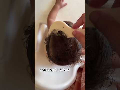 علاج قشرة الشعر عند البيبي 😱 #explore