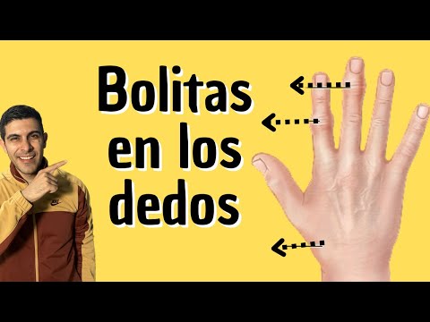 Tenia nódulos en los dedos de las manos ✋