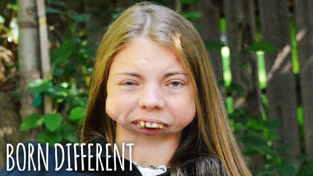 I was born without a jaw - born different