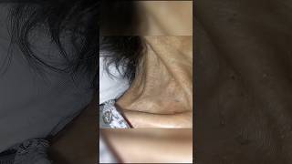 Dancing carotid