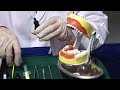 Pit and Fissure Sealants Overview