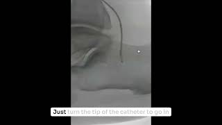 Finding a Path: Foot Recanalization in Low-MAC Disease
