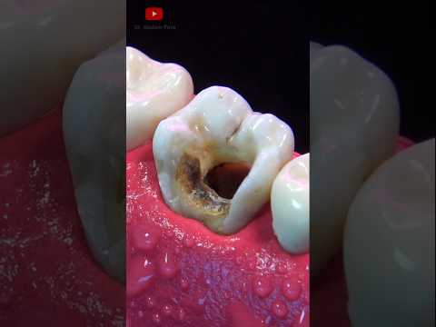 ASOMBROSA restauración dental #asmr