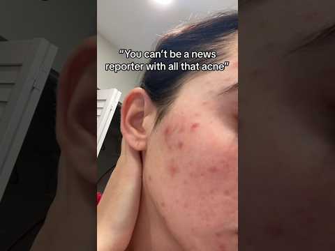 DON’T let your acne control your life!!! #shorts #acne #acneproneskin #hormonalacne #acnepositivity