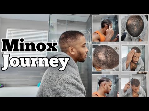 My Hair is Growing… But I RUINED My Haircut! 😱🔥- Week 6 Minoxidil Update