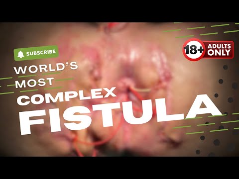 Cured After 18 Failed Surgeries | World's Most Complex Fistula Treated by Dr. Ashwin Porwal | Pune