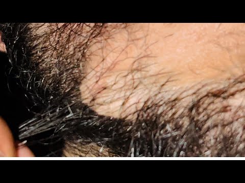 ASMR ODDLY SATISFYING INGROWN HAIR SATISFYING HIR BAD SONG ASMR 208 