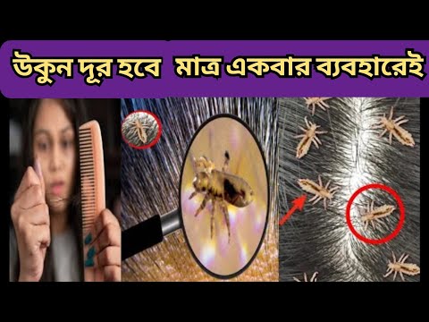 মাথার উকুন আর লিকি চিরতরে ধ্বংস | উকুন দূর করার উপায় | Hair and Beauty Care Tips