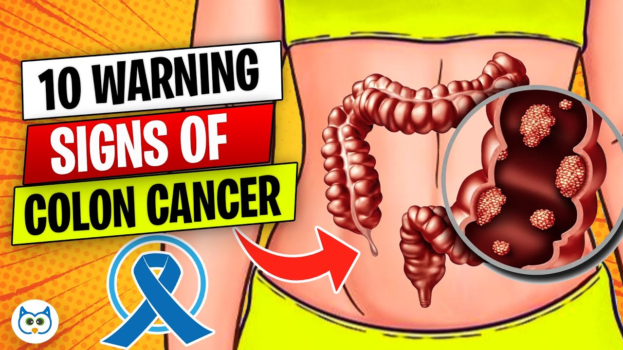 10 WARNING Signs of COLON CANCER You Shouldn’t Ignore