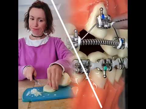 #braces #funny #foreigntraineddentist #storytime