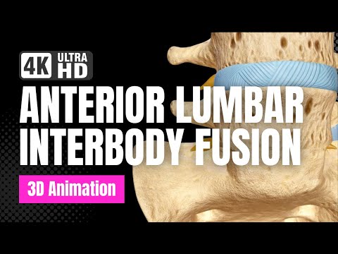 Anterior Lumbar Interbody Fusion (ALIF) - See How It Works - 3D Animation