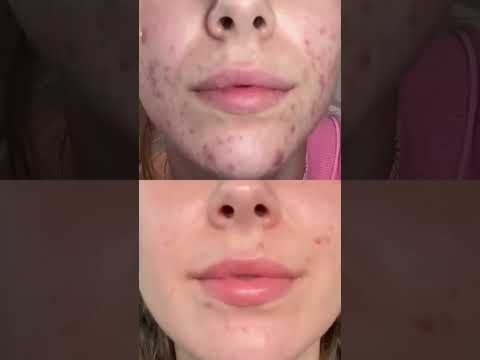 ₹50 Cream That Fights Acne, Pimples & Dark Spots Fast 🔥 #facecream #skincarefirst