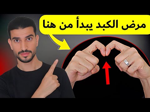 10علامات لمرض الكبد يمكنك رؤيتها !