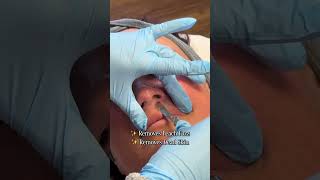 Say GOODBYE to Peach Fuzz & HELLO To Smooth Skin with DERMAPLANING! #skincare #skin #shorts