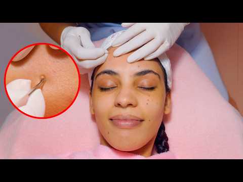 ASMR: Relaxing Hydra Facial Massage with ACNE Removal Treatment for Glowing Skin
