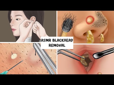 ASMR Blackhead removal collection and treatment to remove secretions caused at eyes nose, head asmr