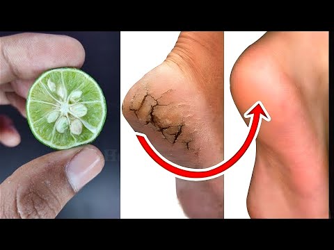 1 ही रात में फटी एड़ियों से छुटकारा पाएं | crack heels home remedy & crack heels treatment in hindi