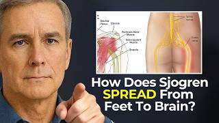 Why Your Sjögren’s Symptoms Seem to Move From One Body Part to Another