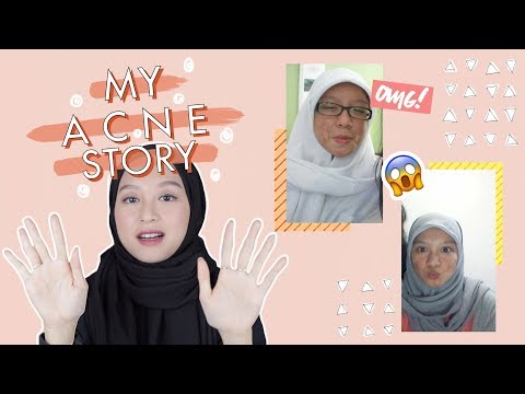 Why I stopped photoshopping my face | Acne story