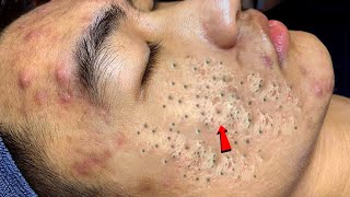 Pimple हटाने के 100% घरेलू उपाय | Acne Treatment at Home | Glowing Face Tips