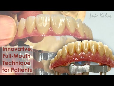 Innovative Technique for Full-Mouth Implant Patients