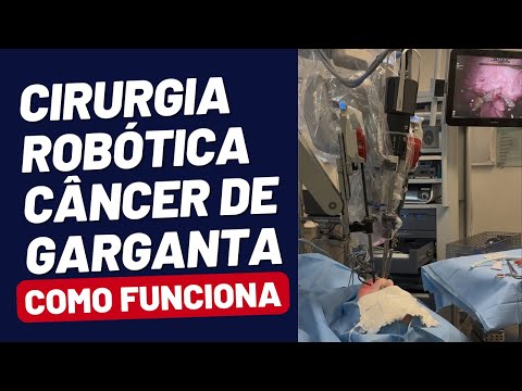 TRATAMENTO NOVO para o Câncer de GARGANTA - TORS - Cirurgia Robótica Transoral