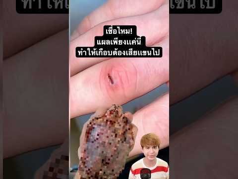 เชื่อไหม! แผลเพียงเเค่นี้ ทำให้คนนี้เกือบต้องเสียเเขนไป #เรื่องนี้ต้องดู #ฟีด #เทรนด์วันนี้