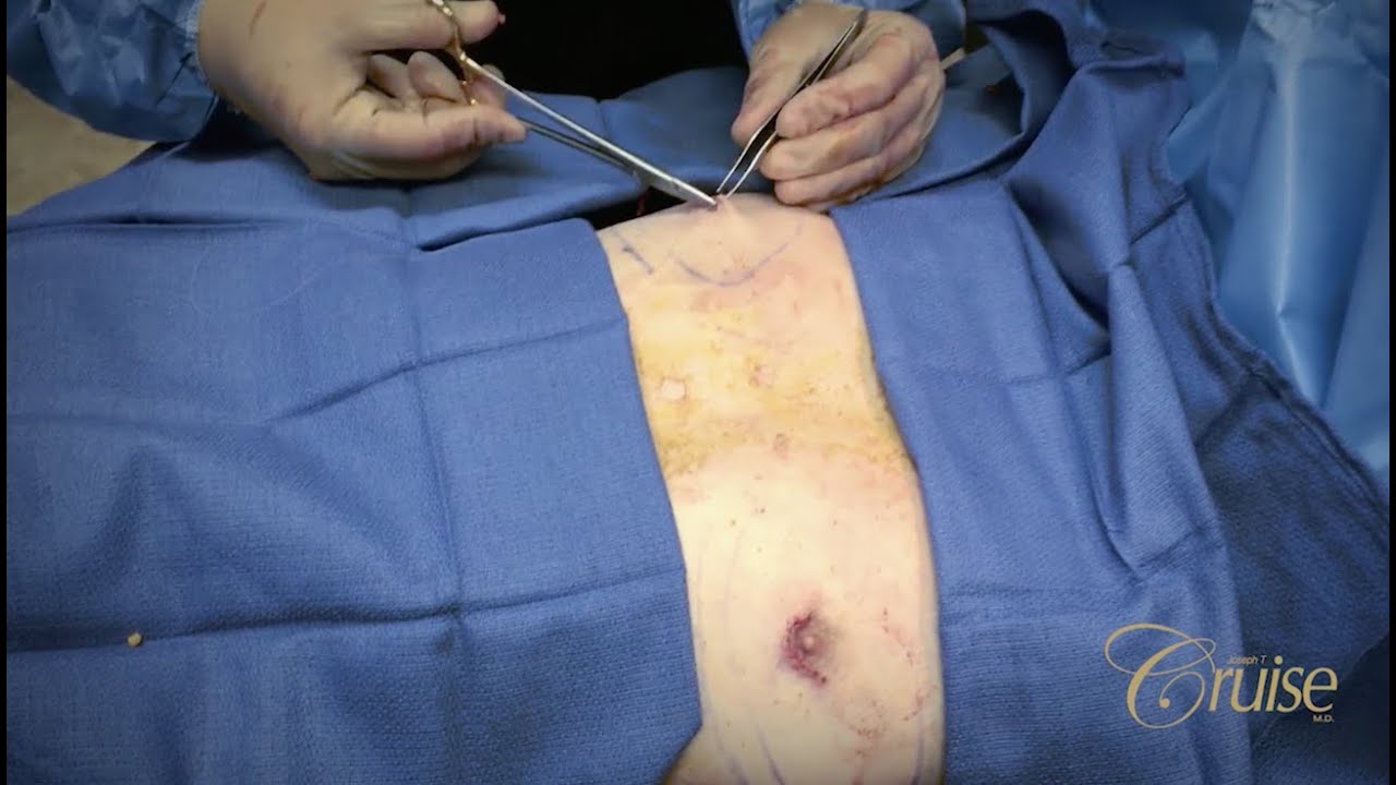 Surgical procedure on patient's abdomen area.