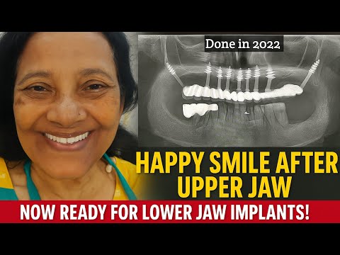 Full Mouth Dental Implant Success | Happy Smile After Upper Jaw | Now Ready for Lower Jaw Implants!