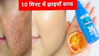 10 मिनट में पुराने से पुराने झाइयों का सफाया ।